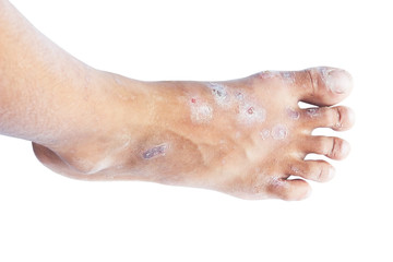 Fototapeta premium Hand foot mouth syndrome. 