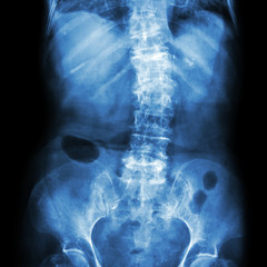 Spondylosis and Scoliosis ( film x-ray lumbar - sacrum spine show crooked spine ) ( old patient ) ( Spine Healthcare )