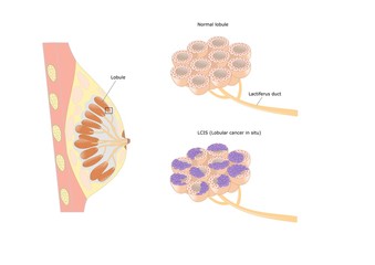 tipologia di cancro al seno: cancro lobulare