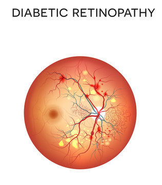 Diabetic retinopathy