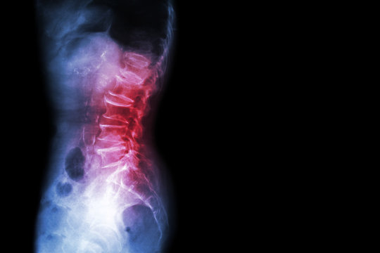 Spondylosis , Spondylolisthesis  ( Film x-ray lumbo - sacral spine show spine collapse , decrease in disc space , bony spur formation ) ( side , lateral view ) and blank area at right side