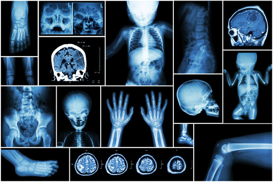 X-ray multiple part of child 's body & multiple disease ( stroke , brain tumor , rheumatoid arthritis , sinusitis , gouty arthritis , etc)( skull chest lung heart spine arm hand pelvis leg knee foot )