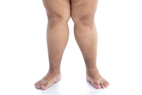 Close up of legs with overweight standing