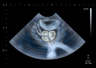 Ultrasound scan of human Prostate. Illustration