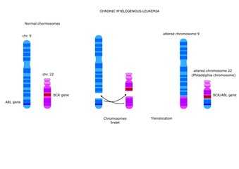 difetto cromosomico portatore della leucemia mieloide cronica (cromosoma Philadelphia)