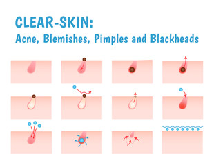 acne skin care