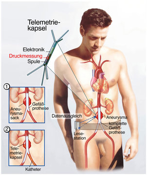 Aneurysma-Gefahr.Leck-&Uuml;berwachung