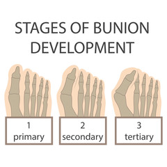 human foot. vector illustration of bunion development