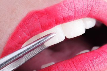 Check-up of the mouth and teeth of a young woman. Close-up photo
