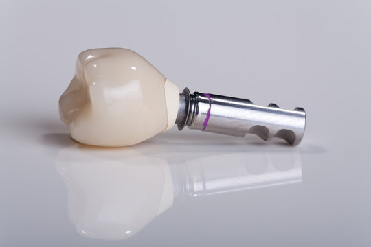 Zahn Implantat Nahaufnahme