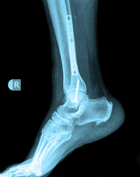 xray of foot by side view with screw
