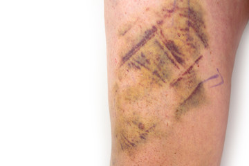 leg after surgery on white background