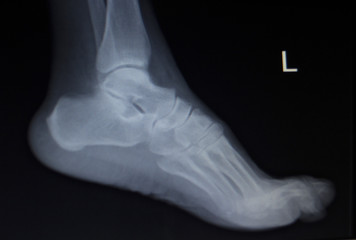 X-ray orthopedics scan of foot injury
