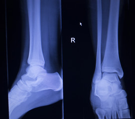 X-ray orthopedics scan of painful ankle foot injury