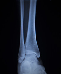 X-ray orthopedics scan of painful ankle foot injury