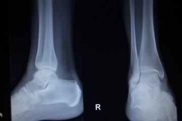 X-ray orthopedics scan of painful ankle foot injury