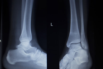 X-ray orthopedics scan of painful ankle foot injury