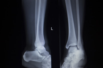 X-ray orthopedics scan of painful ankle foot injury