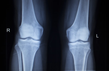 X-ray orthopedics scan of painful knee meniscus leg injury