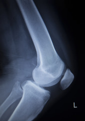 X-ray orthopedics scan of painful knee meniscus leg injury