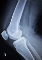 X-ray orthopedics scan of painful knee meniscus leg injury