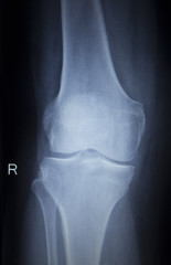 X-ray orthopedics scan of painful knee meniscus leg injury