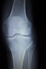 X-ray orthopedics scan of painful knee meniscus leg injury