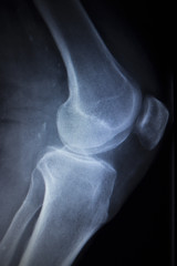 X-ray orthopedics scan of painful knee meniscus leg injury