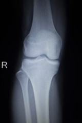 X-ray orthopedics scan of painful knee meniscus leg injury