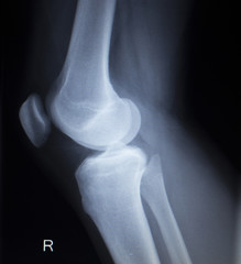 X-ray orthopedics scan of painful knee meniscus leg injury