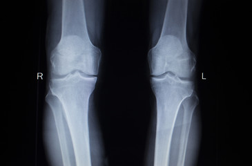 X-ray orthopedics scan of painful knee meniscus leg injury