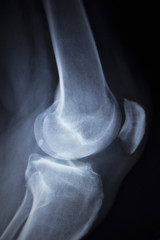X-ray orthopedics scan of painful knee meniscus leg injury