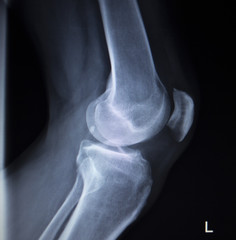 X-ray orthopedics scan of painful knee meniscus leg injury