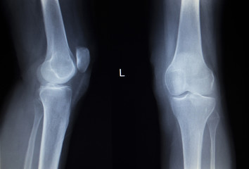X-ray orthopedics scan of painful knee meniscus leg injury