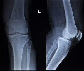 X-ray orthopedics scan of painful knee meniscus leg injury