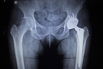 X-ray scan  image of hip joint replacement orthopedic implant