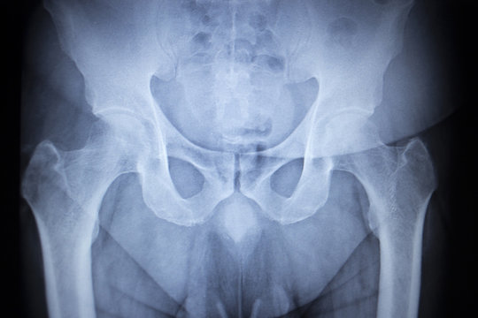 X-ray orthopedic scan  image of hip joints human skeleton