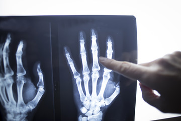 Medical doctor pointing at radiograph x-ray image