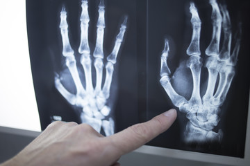 Medical doctor pointing at radiograph x-ray image