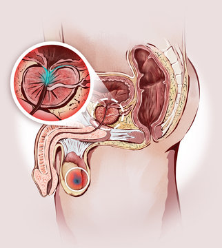Prostata ingrossata e tumore ai testicoli. Organi genitali maschili