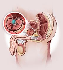 prostata ingrossata e organi genitali maschili: prostatite