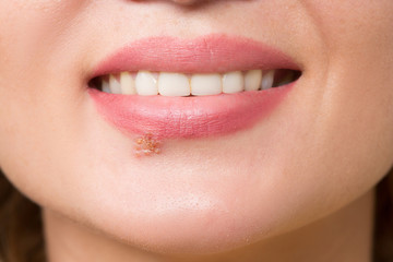 beautiful lips virus infected herpes