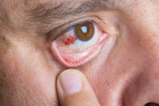 Derrame ocular o hiposfagma en un hombre adulto, enfermedades y cuidado de la vista