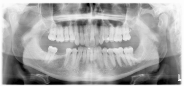 Orthopantomographie Kiefer Zähne