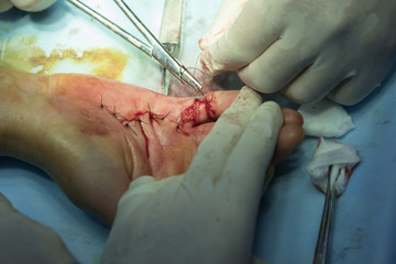 Sutures on a hand
