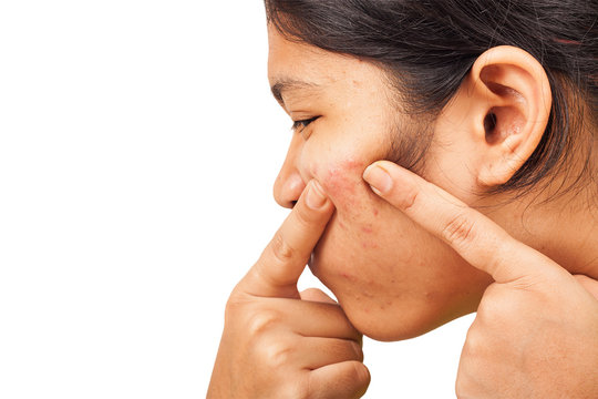acne on face teennager girl