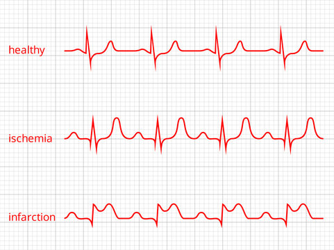 Heart cardiogram vector charts set. Healthy heart rhythm, ischemia, infarction