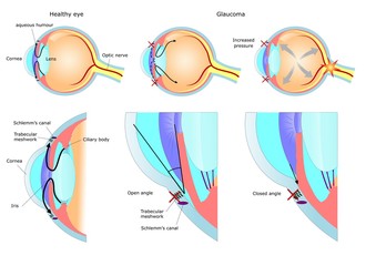 malattia oculare: glaucoma