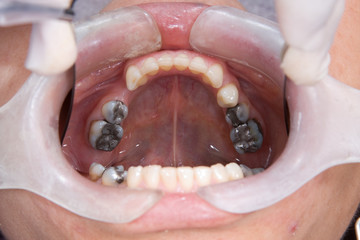 protesis parcial removible