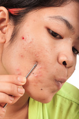 Fototapeta premium acne on skin face women